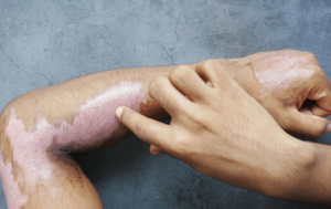 Erythrodermic Psoriasis 