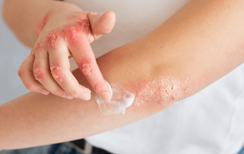 Plaque Psoriasis