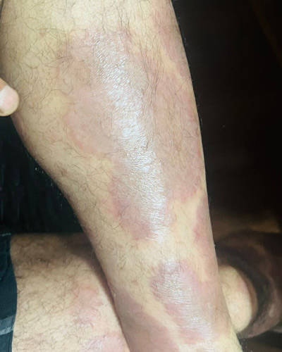 psoriasis-after