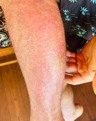 psoriasis-after-2