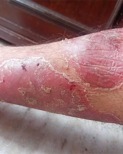psoriasis-before