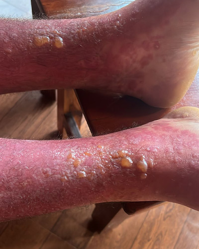 psoriasis-before-2