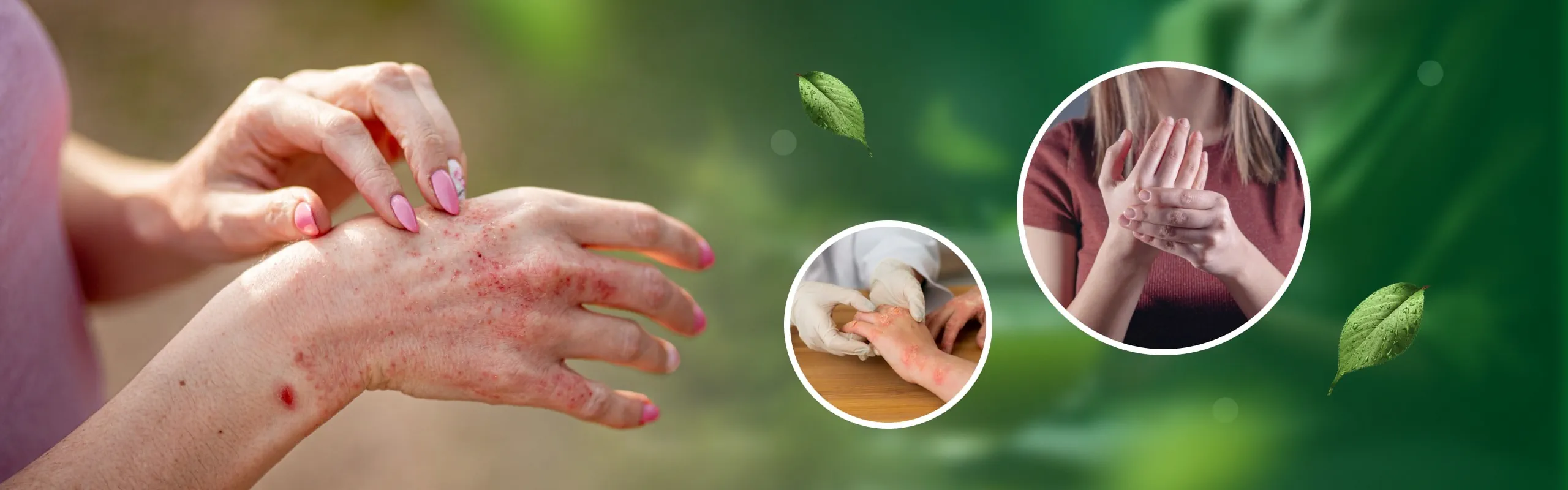 best ayurvedic psoriasis treatment kerala