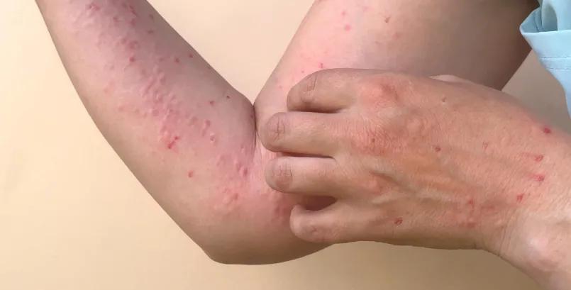 Psoriasis