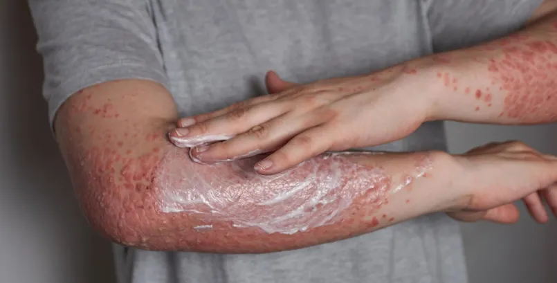 Ayurveda vs Allopathy, cure for psoriasis