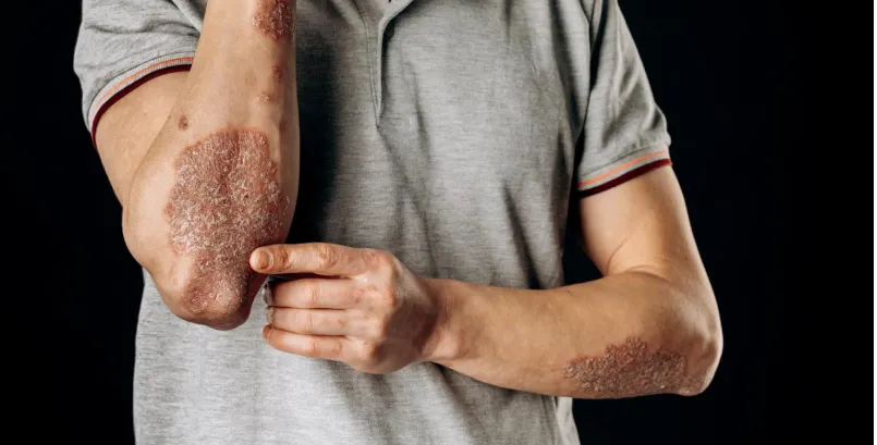 Ayurveda Treatment for Psoriasis