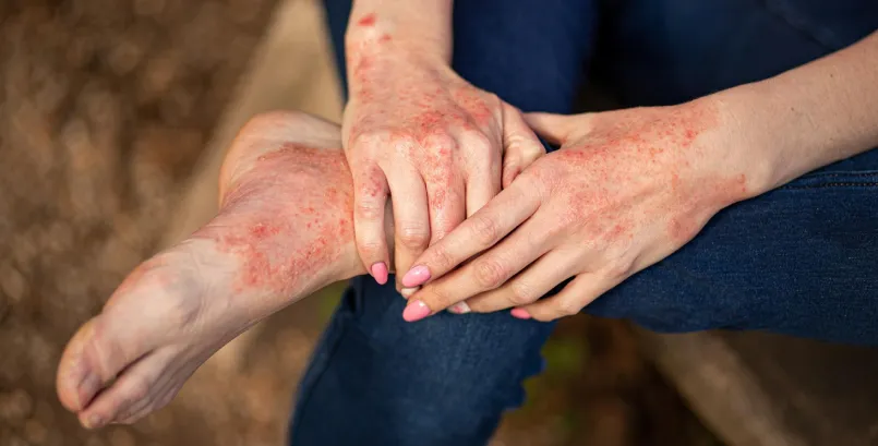 Ayurvedic treatment for Psoriasis