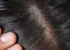 How To Effectively Manage Scalp Psoriasis Using Ayurveda?