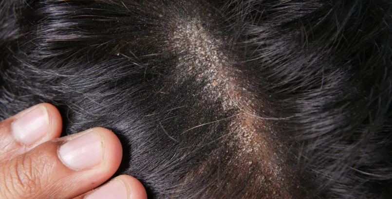Scalp Psoriasis