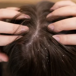 Scalp Psoriasis 
