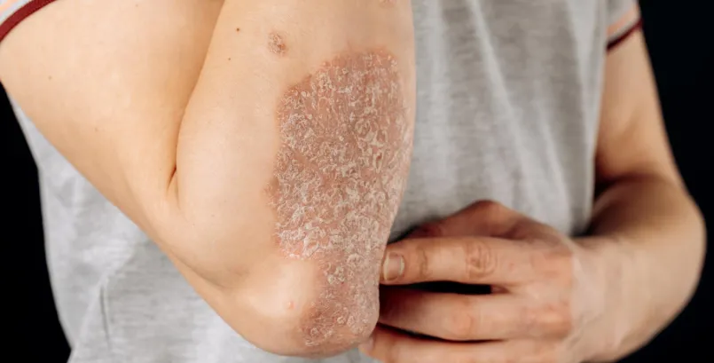 Ayurvedic Psoriasis Treatment