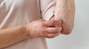  plaque psoriasis 
