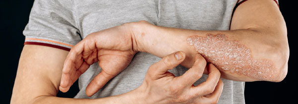 scaly skin patches hands